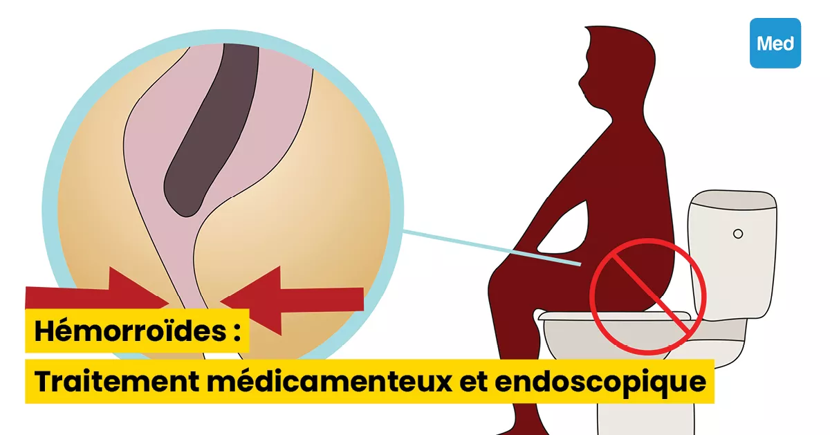 Hémorroïdes : Traitement médicamenteux et endoscopique